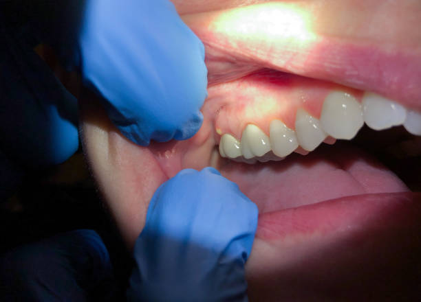 Best Emergency Dentist for Lost Fillings or Crowns in Arrowhead Beach, NC